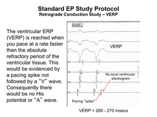 Standard EP Study Protocol
              Retrograde Conduction Study – VERP


The ventricular ERP
(VERP) is reached when
you pace at a rate faster                       VERP
than the absolute
refractory period of the
ventricular tissue. This
would be evidenced by
a pacing spike not                           No local ventricular
                                                 electrogram
followed by a “V” wave.
Consequently there
would be no His
potential or “A” wave.      Pacing “spike”

99                              VERP = 200 - 270 msecs
 