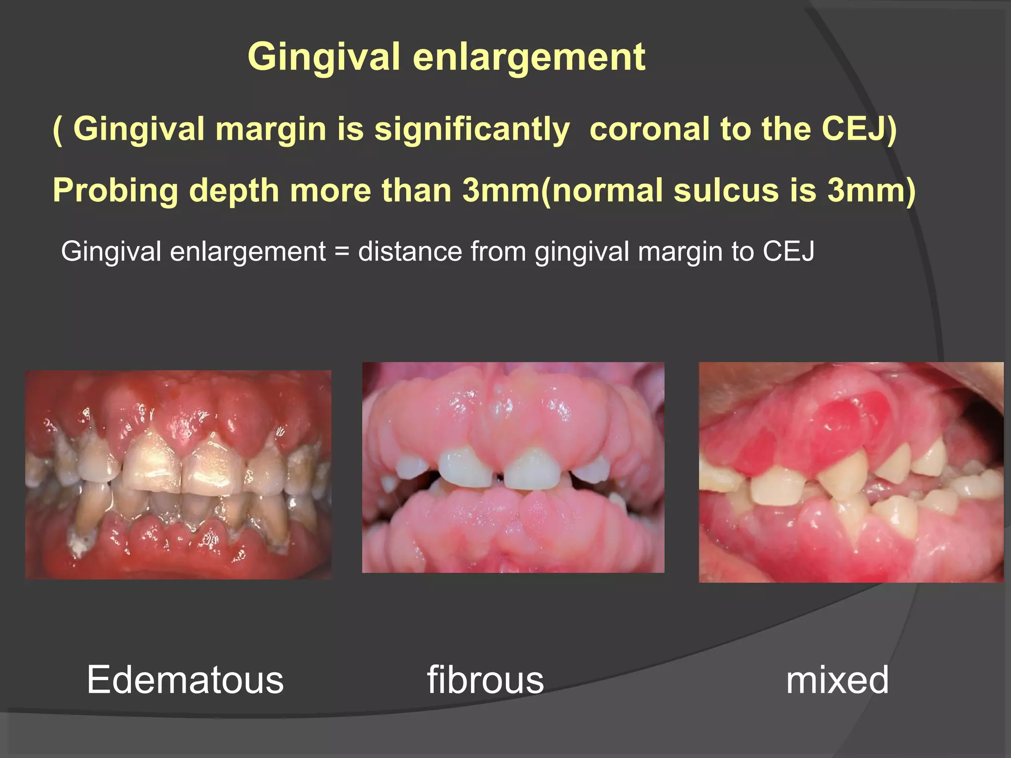 Normal Gingiva Periodontal examination and diagnosis | PPT