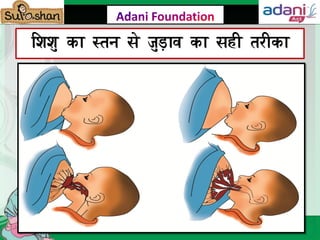 Exclusive Breast Feeding During 1st 6 months