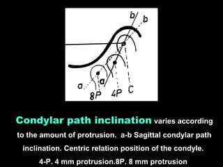 Condylar path inclination varies according
to the amount of protrusion. a-b Sagittal condylar path
inclination. Centric relation position of the condyle.
4-P. 4 mm protrusion.8P. 8 mm protrusion
 