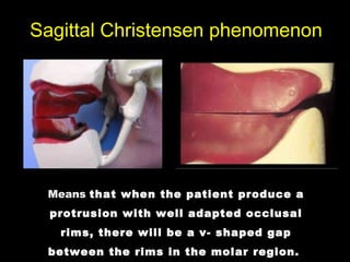 Means that when the patient produce a
protrusion with well adapted occlusal
rims, there will be a v- shaped gap
between the rims in the molar region.
Sagittal Christensen phenomenon
 