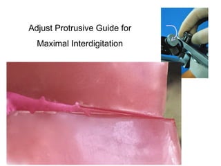 Adjust Protrusive Guide for
Maximal Interdigitation
 