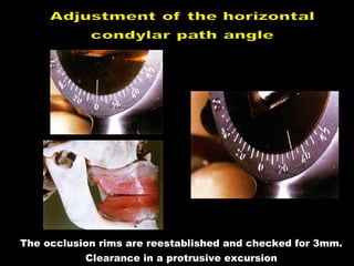 The occlusion rims are reestablished and checked for 3mm.
Clearance in a protrusive excursion
 