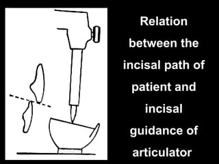 Relation
between the
incisal path of
patient and
incisal
guidance of
articulator
 