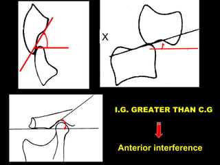 Anterior interference
I.G. GREATER THAN C.G
X
 