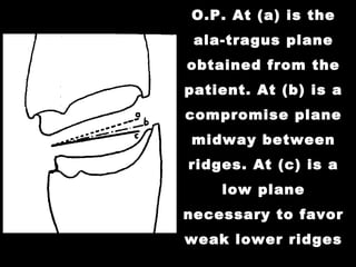 O.P. At (a) is the
ala-tragus plane
obtained from the
patient. At (b) is a
compromise plane
midway between
ridges. At (c) is a
low plane
necessary to favor
weak lower ridges
 