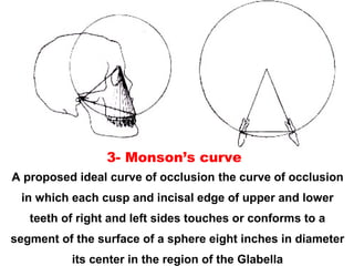 A proposed ideal curve of occlusion the curve of occlusion
in which each cusp and incisal edge of upper and lower
teeth of right and left sides touches or conforms to a
segment of the surface of a sphere eight inches in diameter
its center in the region of the Glabella
3- Monson’s curve
 