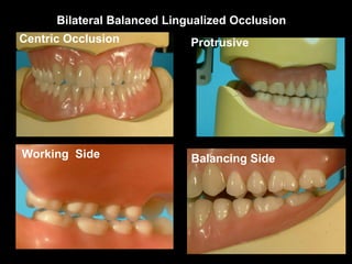 Bilateral Balanced Lingualized Occlusion
Protrusive
Balancing SideWorking Side
Centric Occlusion
 