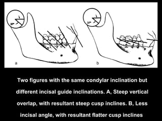 Two figures with the same condylar inclination but
different incisal guide inclinations. A, Steep vertical
overlap, with resultant steep cusp inclines. B, Less
incisal angle, with resultant flatter cusp inclines
a b
 
