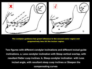 Two figures with different condylar inclinations and different incisal guide
inclinations. a, Less condylar inclination with Steep vertical overlap, with
resultant flatter cusp inclines. b, Steep condylar inclination with Less
incisal angle, with resultant steep cusp inclines or Steepen the
compensating curves
ba
The condylar guidance has great influence in the second molar region and
progressively less till the incisor region.
X
 