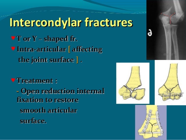 Fracture of Upper Limb