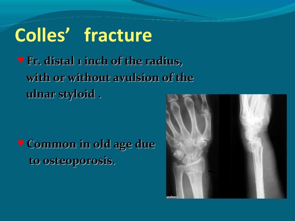 Fracture of Upper Limb