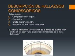 DESCRIPCIÓN DE HALLAZGOS
GONIOSCÓPICOS
Deben incluir:
a) Configuración del ángulo.
b) Profundidad.
c) Grado de pigmentación.
d) Presencia de estructuras anormales.

Ej.:“ángulo abierto con visualización de la banda del cuerpo ciliar
 ancha en los 360° y una pigmentación moderada de la malla
 trabecular”
 