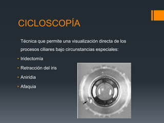 CICLOSCOPÍA
 Técnica que permite una visualización directa de los
 procesos ciliares bajo circunstancias especiales:

• Iridectomía

• Retracción del iris

• Aniridia

• Afaquia
 