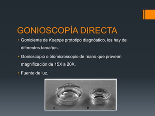 GONIOSCOPÍA DIRECTA
• Goniolente de Koeppe prototipo diagnóstico, los hay de
 diferentes tamaños.

• Gonioscopio o biomicroscopio de mano que proveen
 magnificación de 15X a 20X.

• Fuente de luz.
 