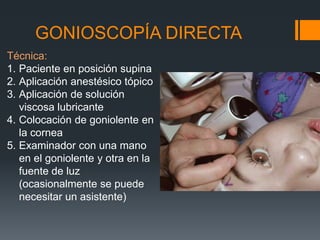 GONIOSCOPÍA DIRECTA
Técnica:
1. Paciente en posición supina
2. Aplicación anestésico tópico
3. Aplicación de solución
   viscosa lubricante
4. Colocación de goniolente en
   la cornea
5. Examinador con una mano
   en el goniolente y otra en la
   fuente de luz
   (ocasionalmente se puede
   necesitar un asistente)
 