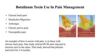 Botulinum Toxin Use In Pain Management
• Chronic back pain
• Headaches/Migraines
• Arthralgia
• Chronic pelvic pain
• Neuropathic pain
An example of how it assists with pain, is in those with
chronic back pain. One study utilized 40-50 units injected in
muscles next to the spine. That study showed that patients
had relief for 3-4 months.
 