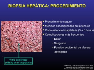 BIOPSIA HEPÁTICA: PROCEDIMIENTO


                            Procedimiento seguro
                            Médicos especializados en la técnica
                            Corta estancia hospitalaria (3 a 6 horas)
                            Complicaciones más frecuentes
                                  –   Dolor
                                  –   Sangrado
                                  –   Punción accidental de víscera
                                      adyacente

   Vidrio esmerilado
(HBsAg en el citoplasma)
                                              Shiffman ML. AASLD: Postgraduate course 2003.
                                                  Keefe EB. AASLD: Postgraduate course 2003.
                                              Friedman LS. AASLD: Postgraduate course 2003.
 