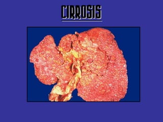 CIRROSIS
 
