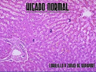 HIGADO NORMAL




      Lobulillo y Zonas de Rapaport
 