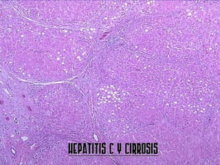 HEPATITIS C Y CIRROSIS
 
