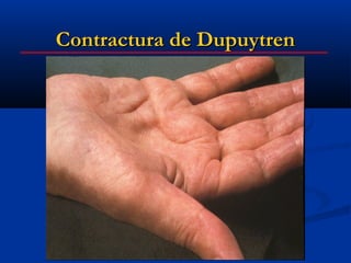 Contractura de Dupuytren
 