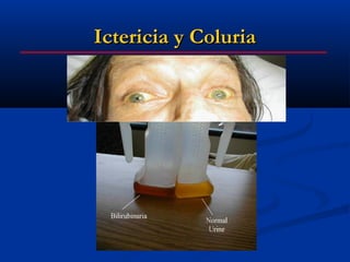 Ictericia y Coluria
 