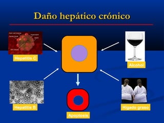 Daño hepático crónico



Hepatitis C
                              Alcohol




Hepatitis B                 Hígado graso
                Apoptosis
 