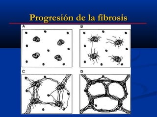 Progresión de la fibrosis
 