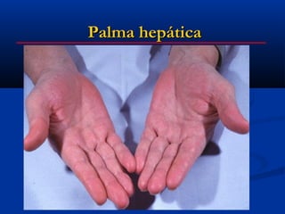 Palma hepática
 