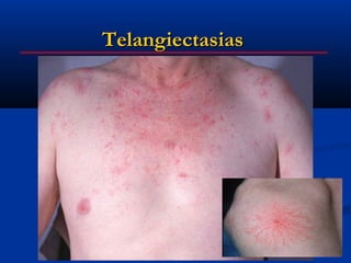 Telangiectasias
 