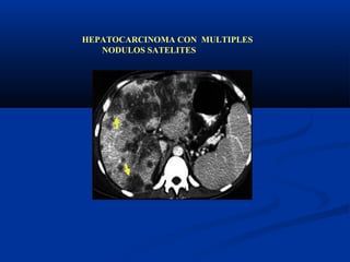 HEPATOCARCINOMA CON MULTIPLES
   NODULOS SATELITES
 