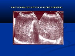 GRAN TUMORACION HEPATICA EN LOBULO DERECHO
 