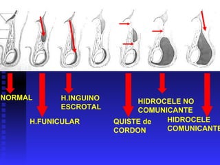 NORMAL H.FUNICULAR H.INGUINO ESCROTAL QUISTE de CORDON HIDROCELE NO COMUNICANTE HIDROCELE  COMUNICANTE 