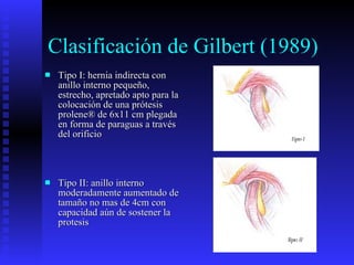 Clasificación de Gilbert (1989) Tipo I: hernia indirecta con anillo interno pequeño, estrecho, apretado apto para la colocación de una prótesis prolene® de 6x11 cm plegada en forma de paraguas a través del orificio Tipo II: anillo interno moderadamente aumentado de tamaño no mas de 4cm con capacidad aún de sostener la protesis  