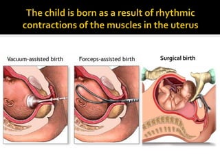 Surgical birth
 