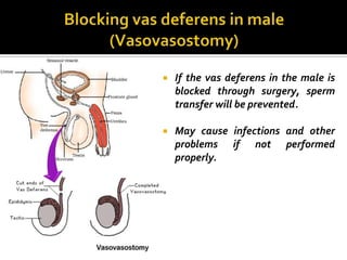    If the vas deferens in the male is
    blocked through surgery, sperm
    transfer will be prevented.

   May cause infections and other
    problems if not performed
    properly.
 