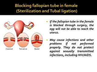    If the fallopian tube in the female
    is blocked through surgery, the
    egg will not be able to reach the
    uterus.

   May cause infections and other
    problems if not performed
    properly. They do not protect
    against sexually transmitted
    infections, including HIV/AIDS.
 