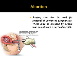    Surgery can also be used for
    removal of unwanted pregnancies.
    These may be misused by people
    who do not want a particular child.
 