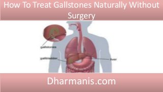 How To Treat Gallstones Naturally Without
Surgery
Dharmanis.com
 