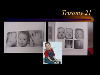 Trisomy 21
 
