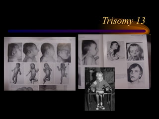 Trisomy 13
 