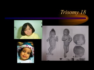 Trisomy 18
 