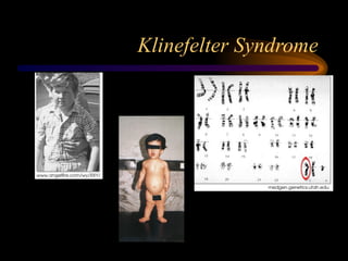 Klinefelter Syndrome
 