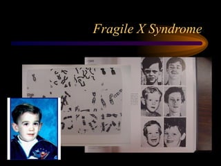Fragile X Syndrome
 