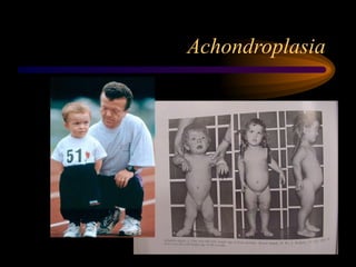 Achondroplasia
 