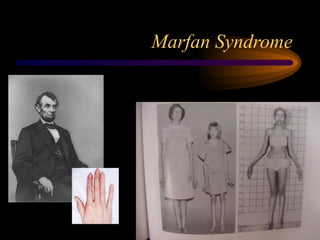 Marfan Syndrome
 