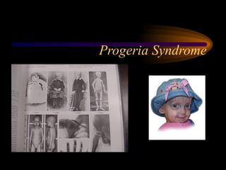 Progeria Syndrome
 