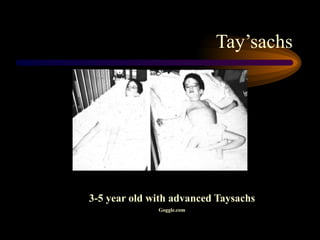 Tay’sachs
3-5 year old with advanced Taysachs
Goggle.com
 