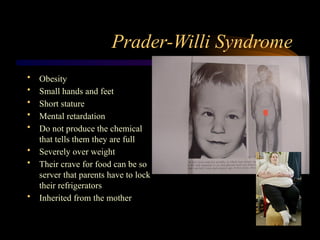 Prader-Willi Syndrome
• Obesity
• Small hands and feet
• Short stature
• Mental retardation
• Do not produce the chemical
that tells them they are full
• Severely over weight
• Their crave for food can be so
server that parents have to lock
their refrigerators
• Inherited from the mother
 